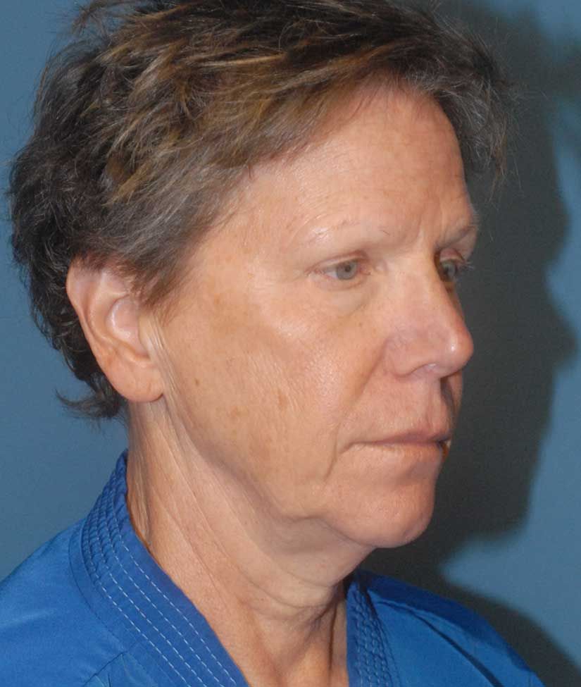 Female Facial Rejuvenation Before & After