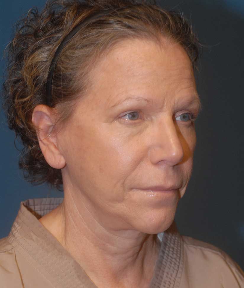 Female Facial Rejuvenation Before & After