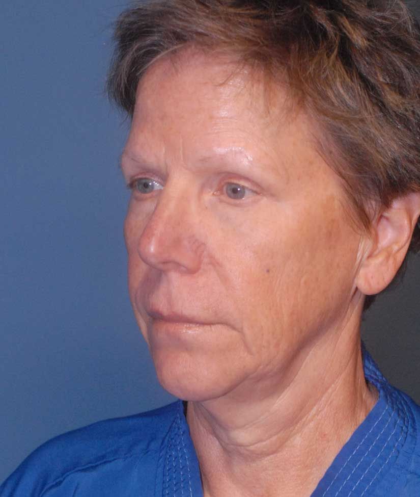 Female Facial Rejuvenation Before & After