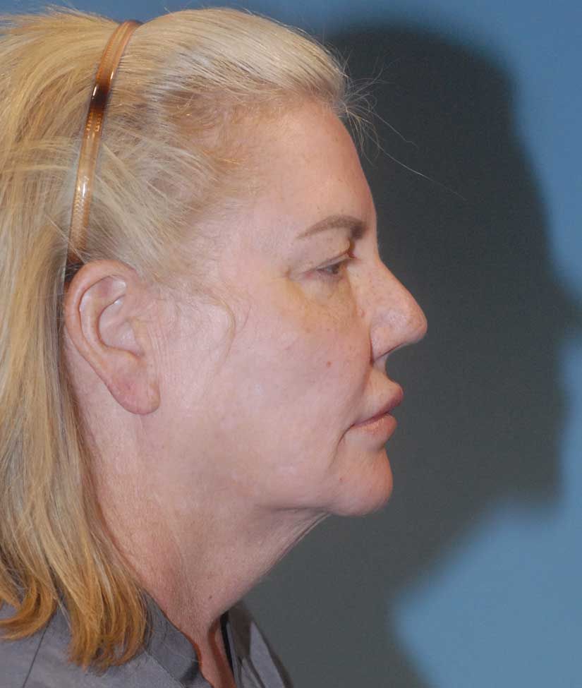 Female Facial Rejuvenation Before & After