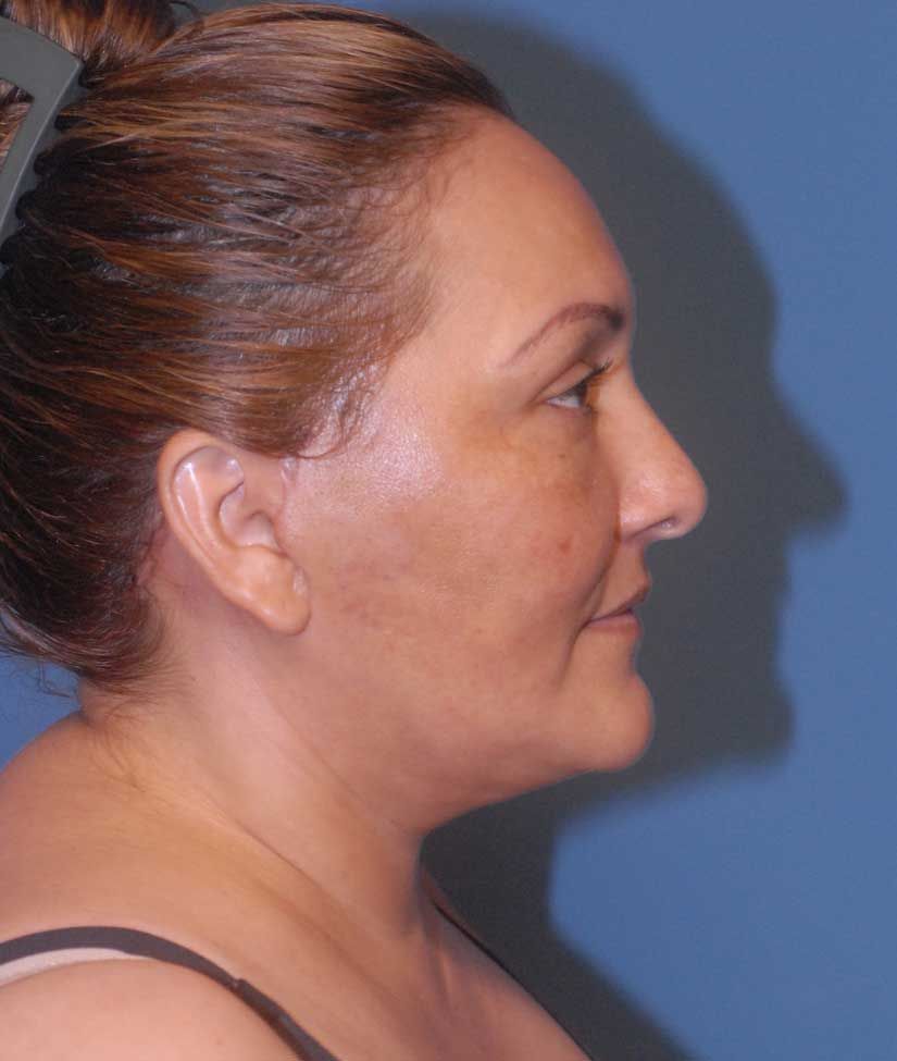 Female Facial Rejuvenation Before & After