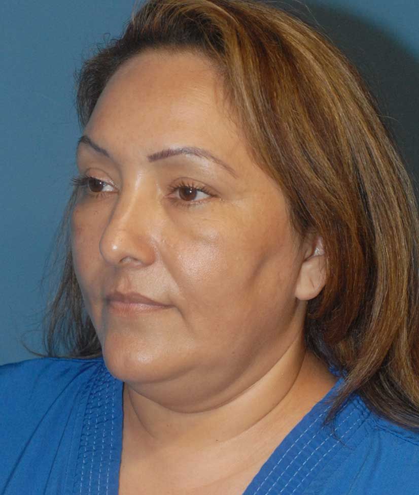 Female Facial Rejuvenation Before & After