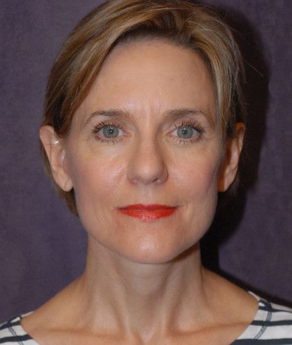 Female Facial Rejuvenation Before & After