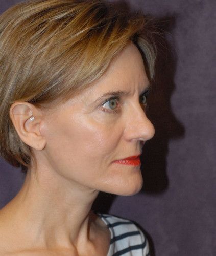 Female Facial Rejuvenation Before & After