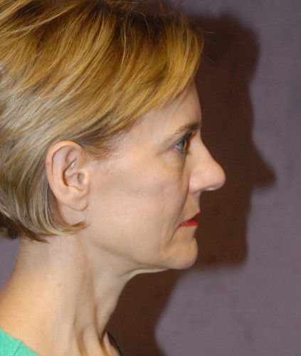 Female Facial Rejuvenation Before & After