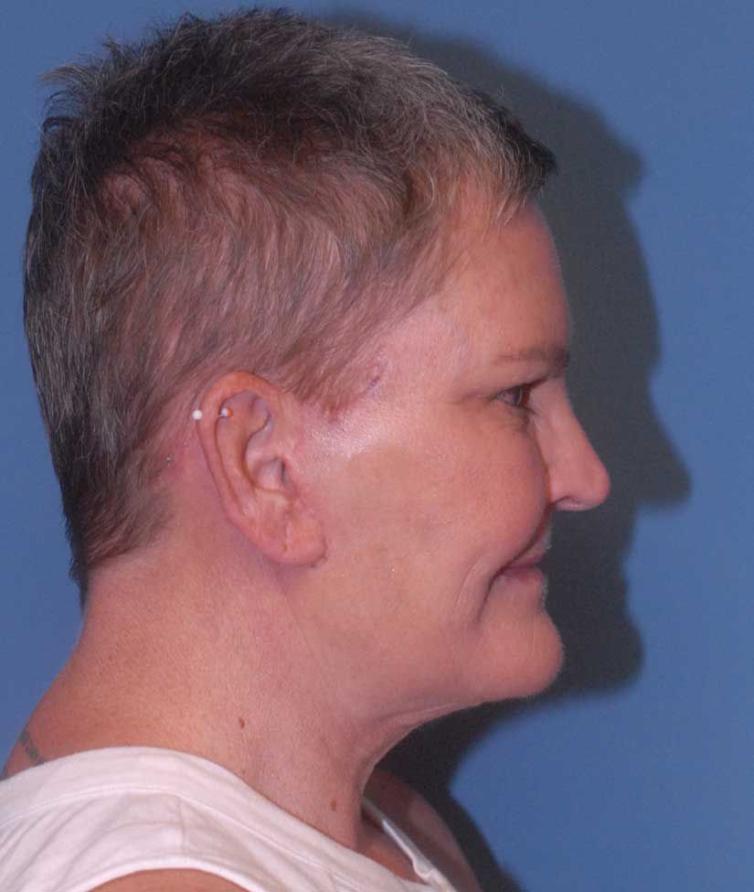 Female Facial Rejuvenation Before & After