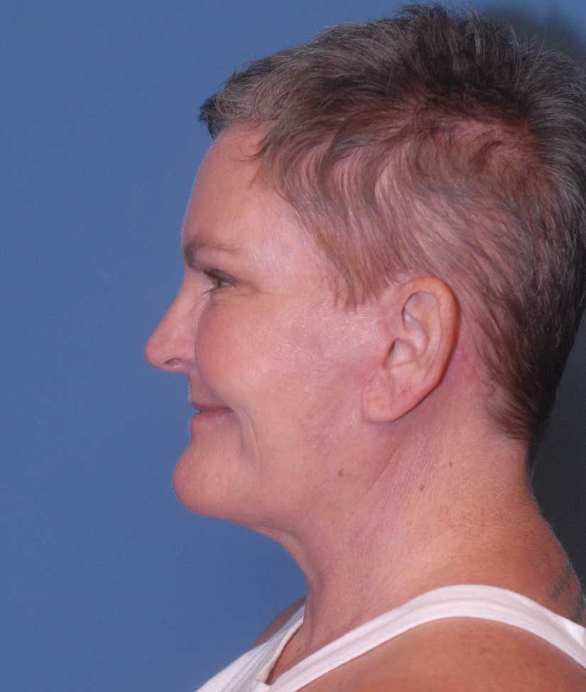 Female Facial Rejuvenation Before & After