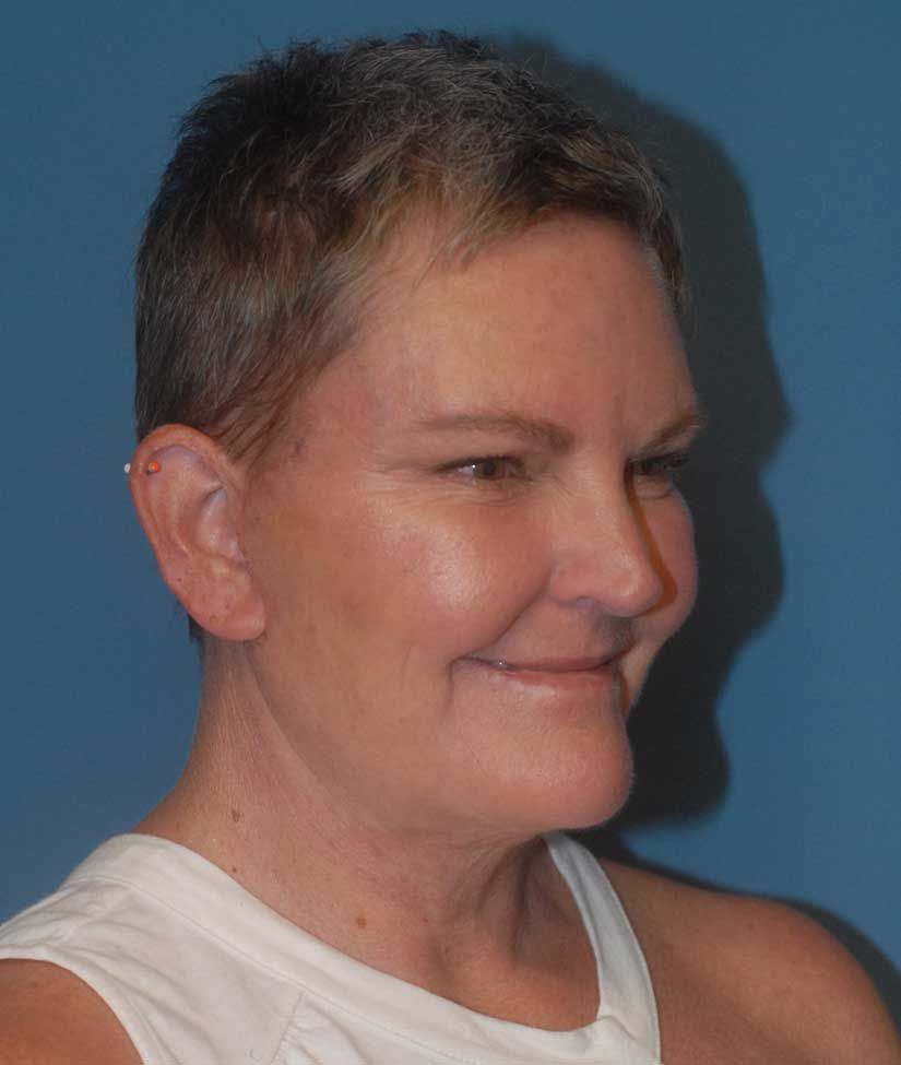 Female Facial Rejuvenation Before & After