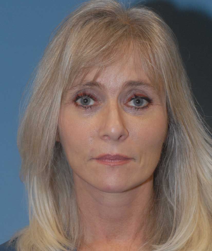 Female Facial Rejuvenation Before & After