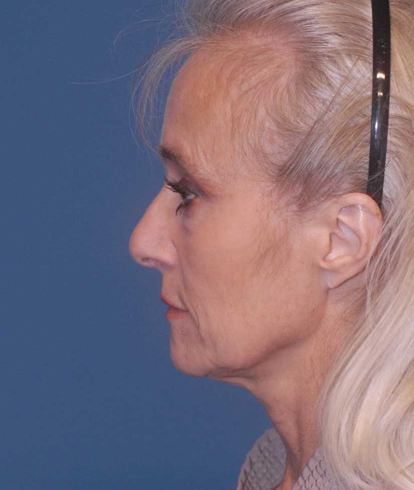 Female Facial Rejuvenation Before & After