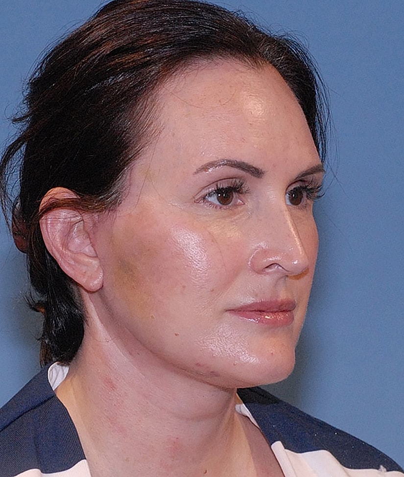 Female Facial Rejuvenation Before & After