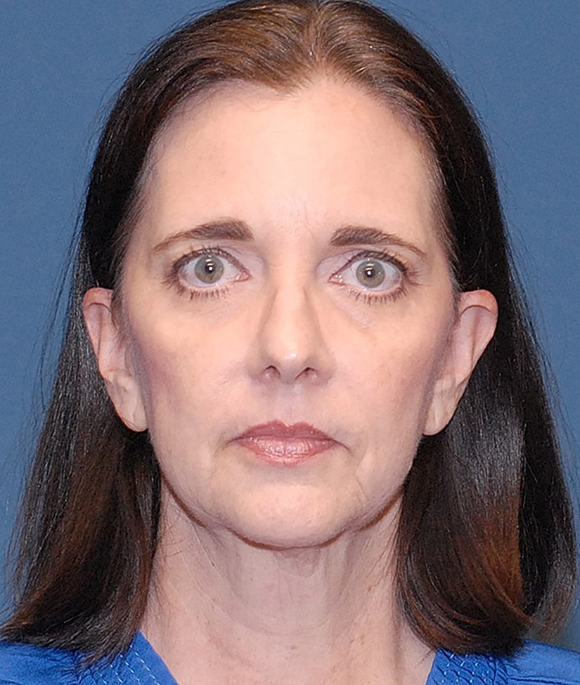 Female Facial Rejuvenation Before & After