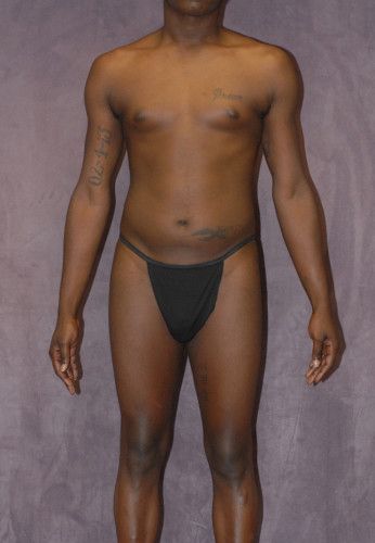 Male To Female Body Contouring Before & After