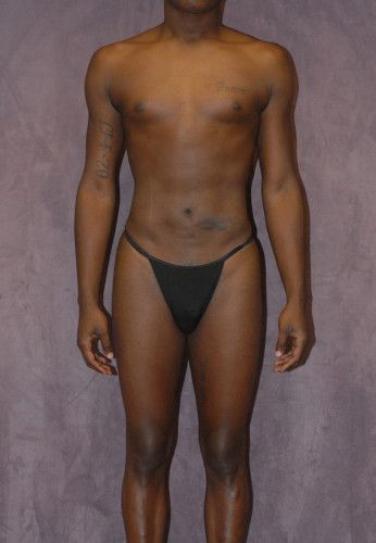 Male To Female Body Contouring Before & After