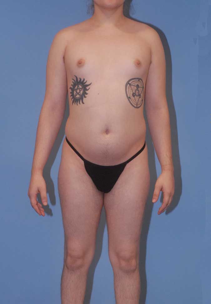 Male To Female Body Contouring Before & After