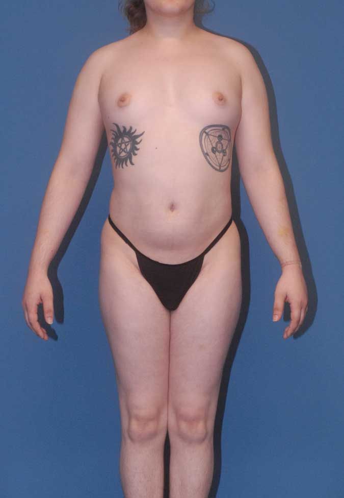 Male To Female Body Contouring Before & After