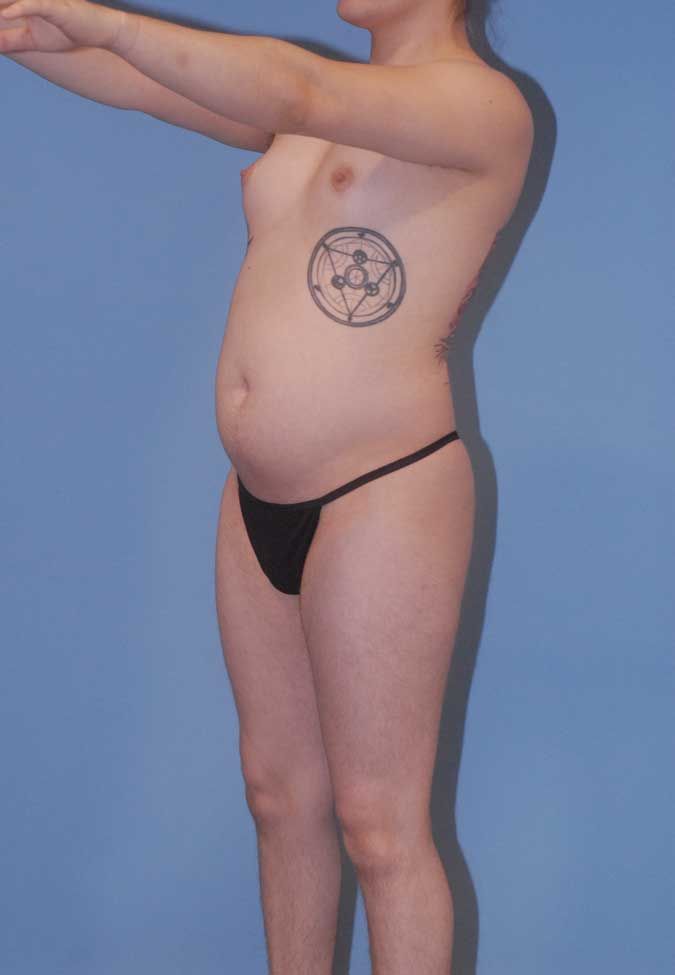 Male To Female Body Contouring Before & After