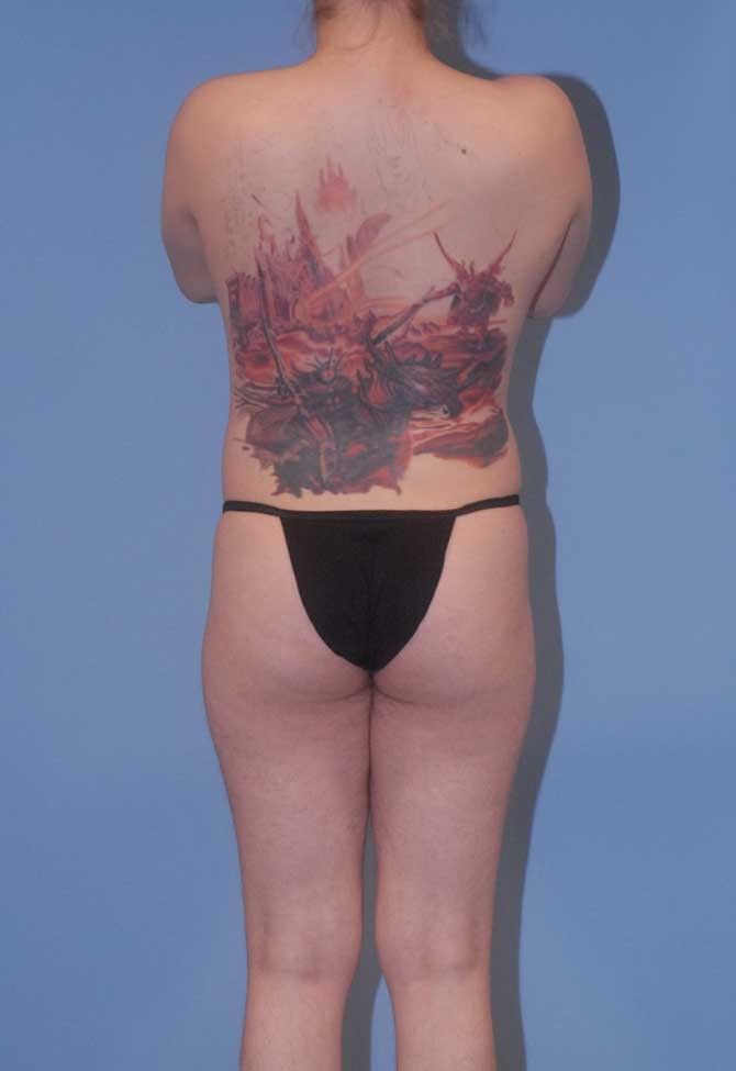 Male To Female Body Contouring Before & After