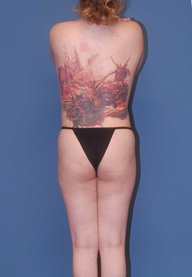 Male To Female Body Contouring Before & After