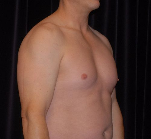 Male Body Contouring Before & After
