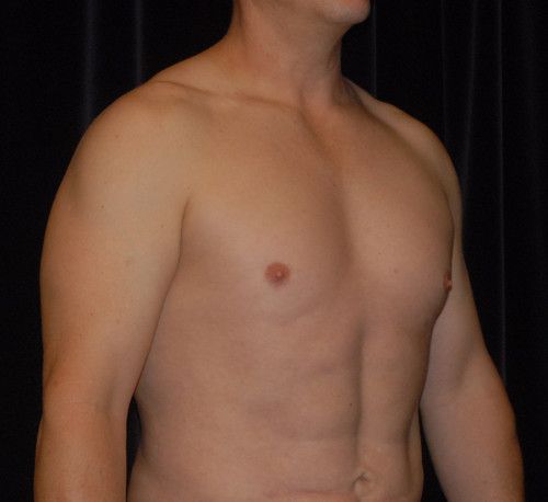 Male Body Contouring Before & After