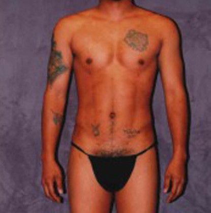 Male Body Contouring Before & After