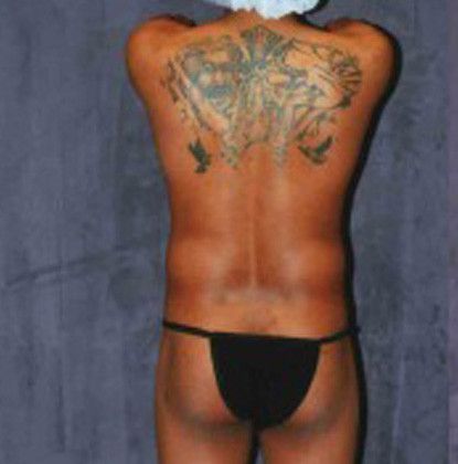 Male Body Contouring Before & After