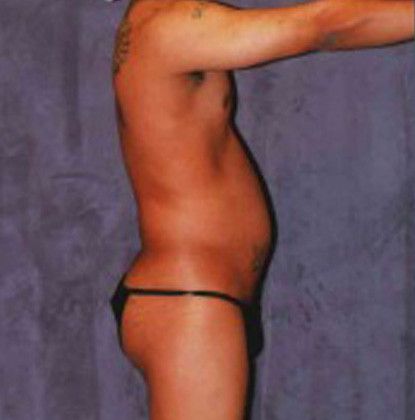 Male Body Contouring Before & After