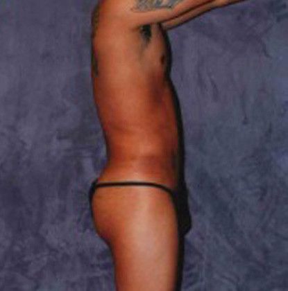 Male Body Contouring Before & After