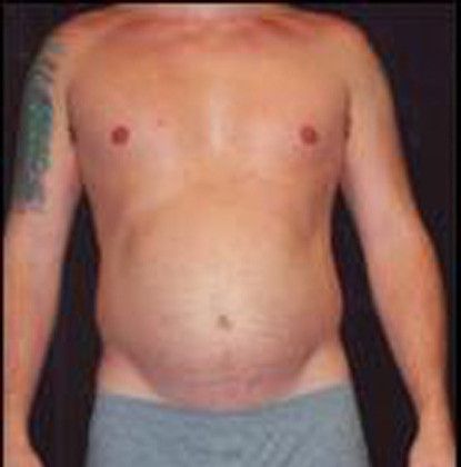 Male Body Contouring Before & After