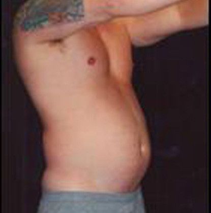 Male Body Contouring Before & After