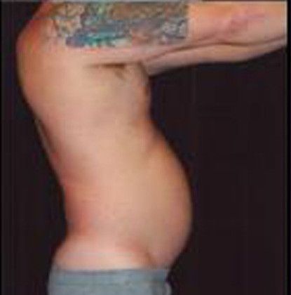 Male Body Contouring Before & After