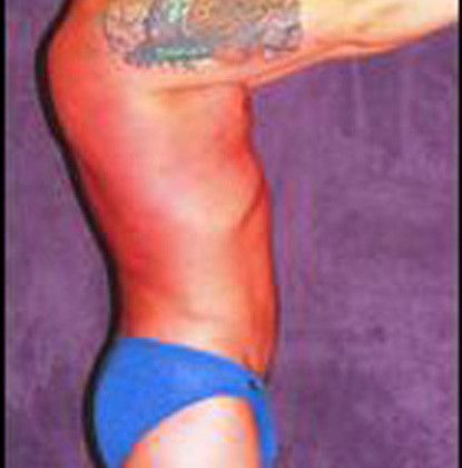 Male Body Contouring Before & After