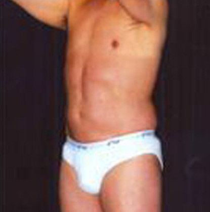 Male Body Contouring Before & After