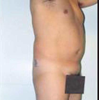 Male Body Contouring Before & After