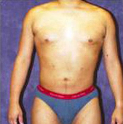 Male Body Contouring Before & After