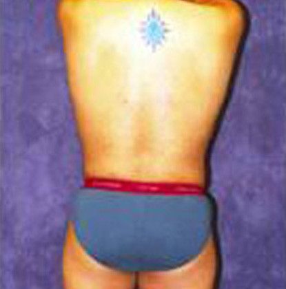 Male Body Contouring Before & After