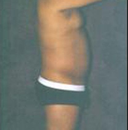 Male Body Contouring Before & After