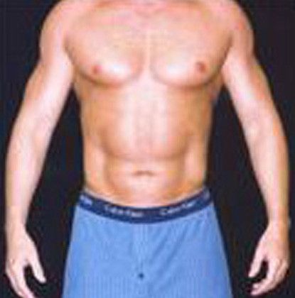 Male Body Contouring Before & After