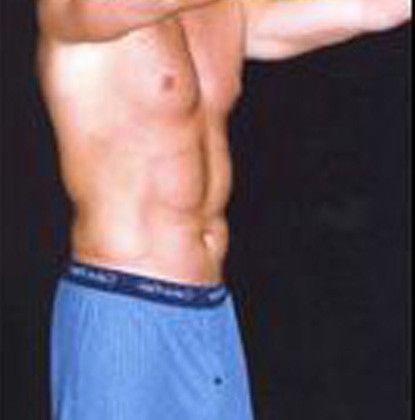 Male Body Contouring Before & After