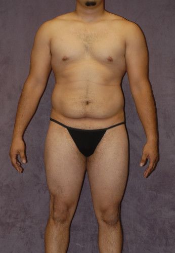 Male Body Contouring Before & After