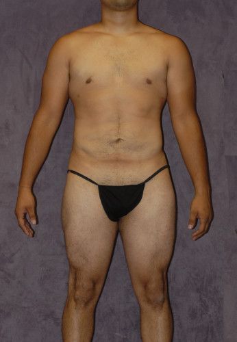 Male Body Contouring Before & After