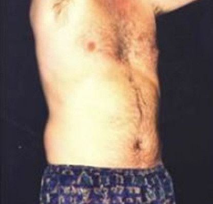 Male Body Contouring Before & After