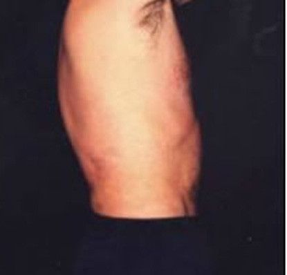 Male Body Contouring Before & After