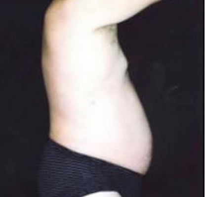 Male Body Contouring Before & After