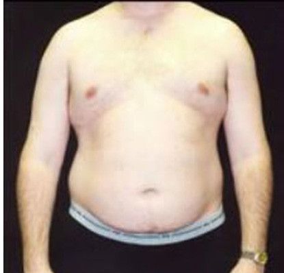 Male Body Contouring Before & After