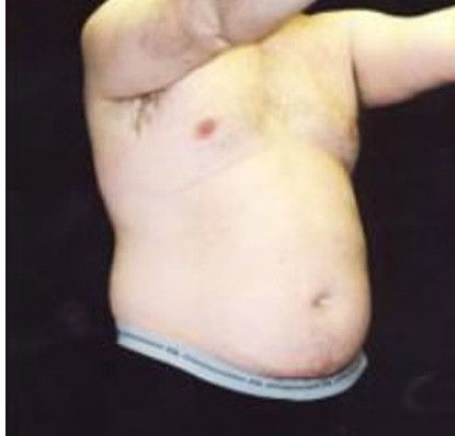 Male Body Contouring Before & After