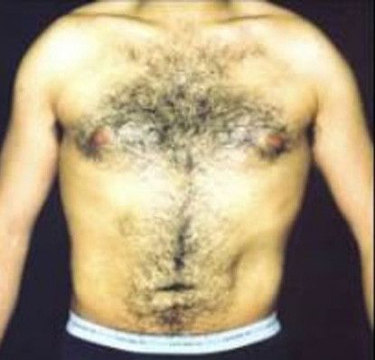 Male Body Contouring Before & After