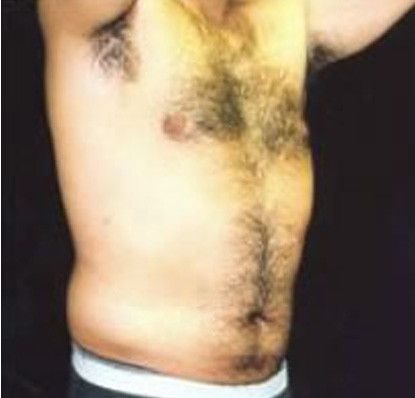 Male Body Contouring Before & After