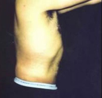 Male Body Contouring Before & After